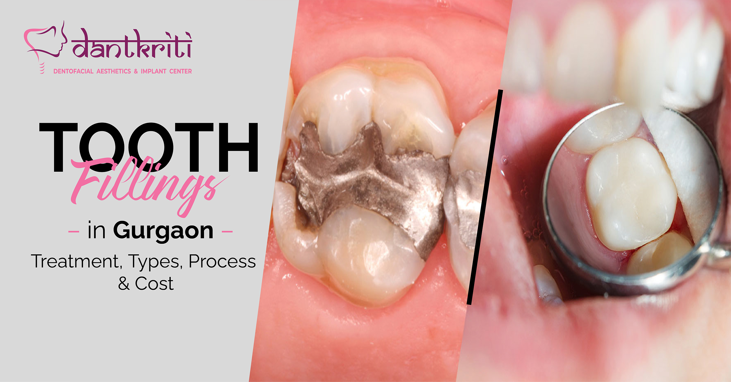 TOOTH FILLINGS IN GURGAON: TREATMENT, TYPES, PROCESS & COST